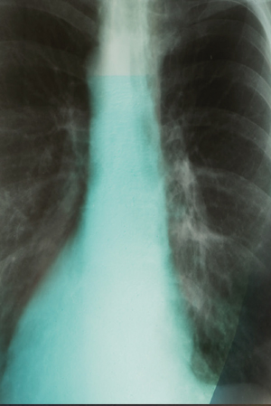 FCCC Lung Cancer Screening